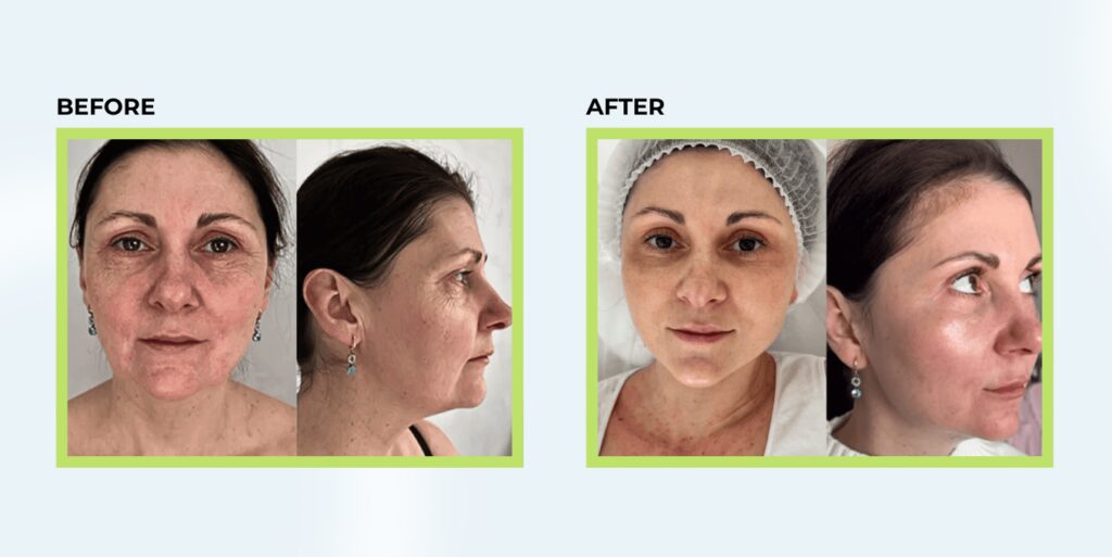 BEAUX (PDLLA + HA) before and after results