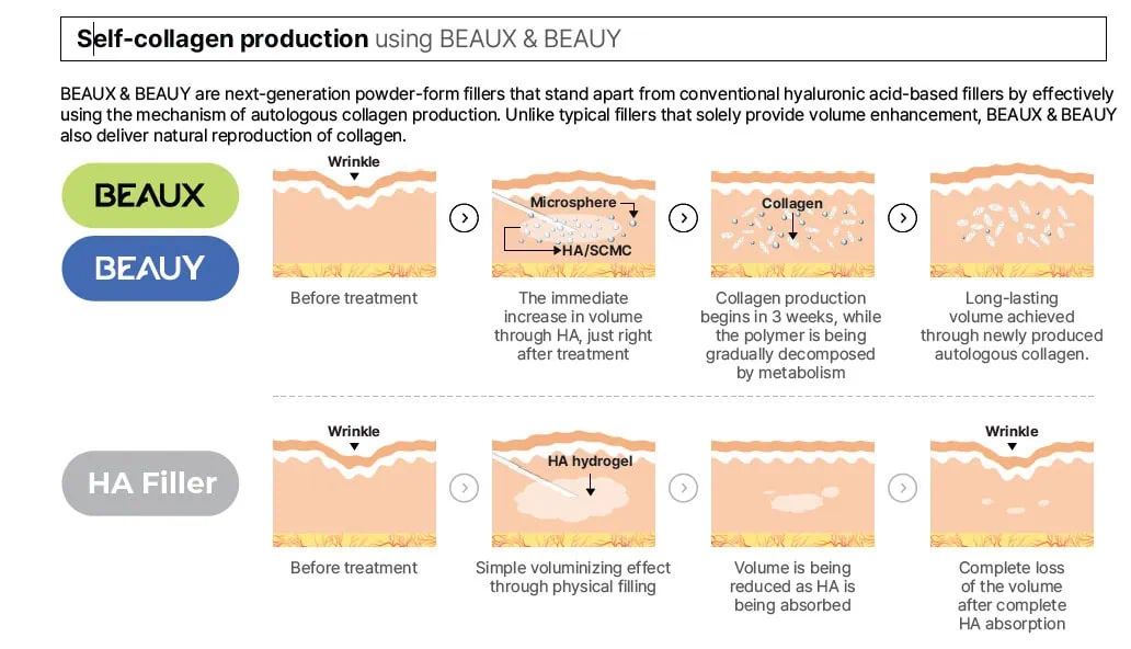 How BEAUX Stands Out Compared to Standard HA Fillers