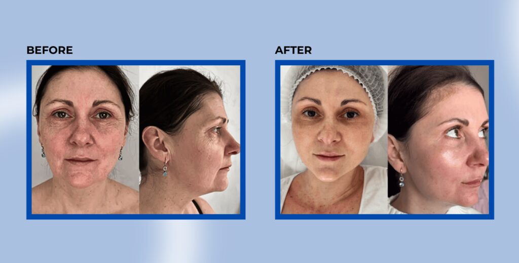 BEAUY (PLLA 200) before and after results