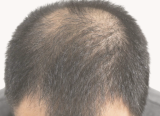Androgenetic Alopecia