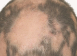 Alopecia Areata