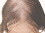 Diffuse alopecia (Telogen or Anagen Effluvium)