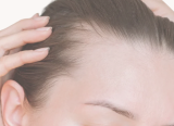 Traction Alopecia