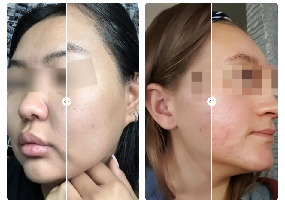Jeunetique Exo before and after results