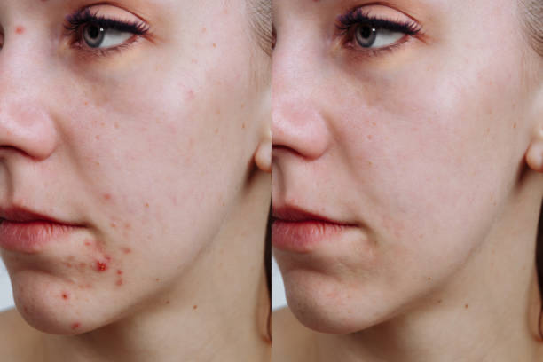 Micro-damage to the skin, such as post-acne, decreased by 7.3%