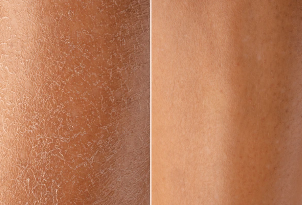 The activity of antioxidant mechanisms in the dermis increased by 11.2%