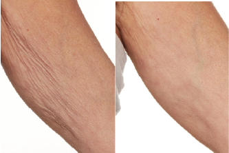 The levels of the skin's main structural proteins, collagen and elastin, increased by 21.3%