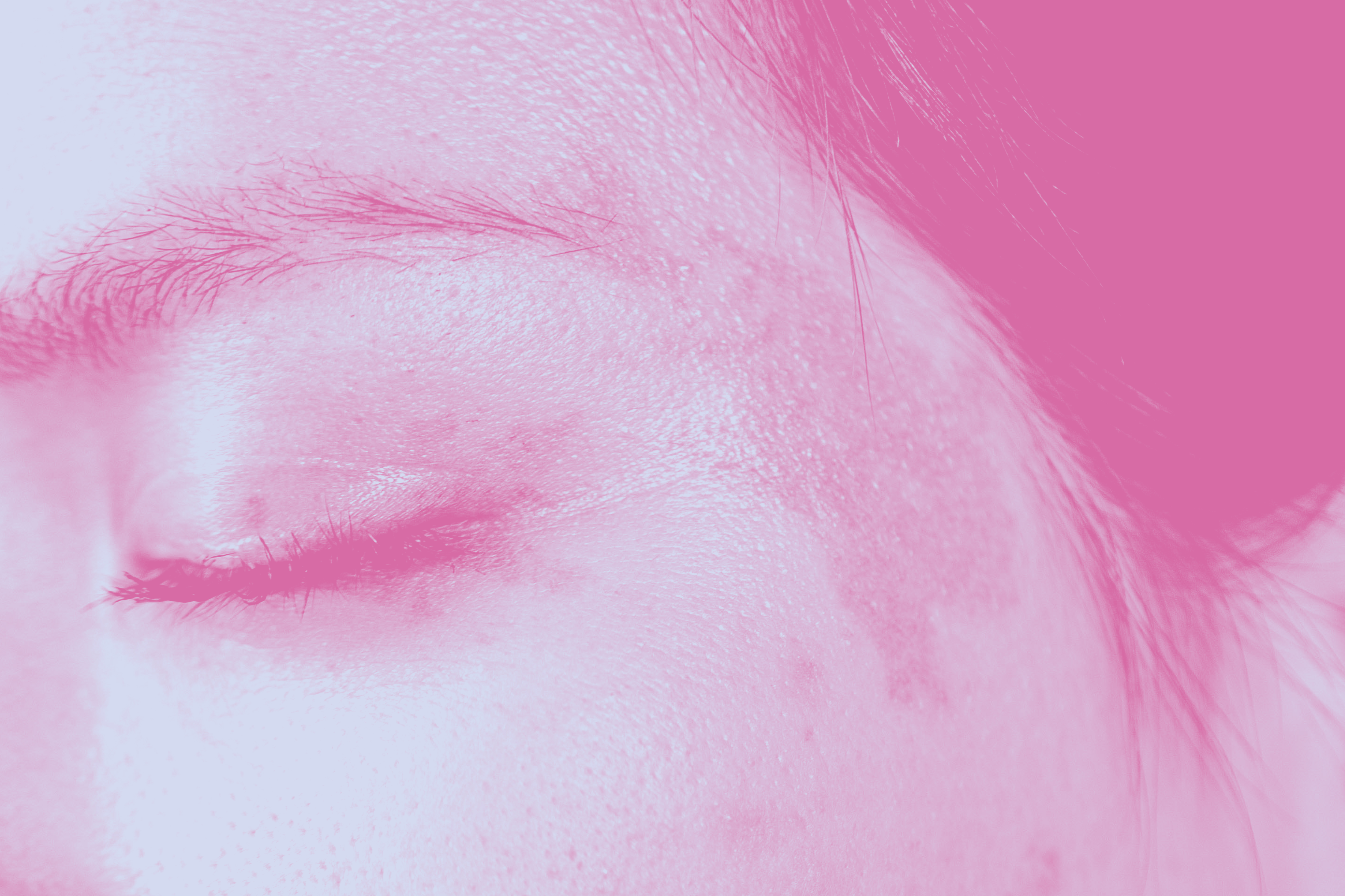 Photoaging and pigmentation