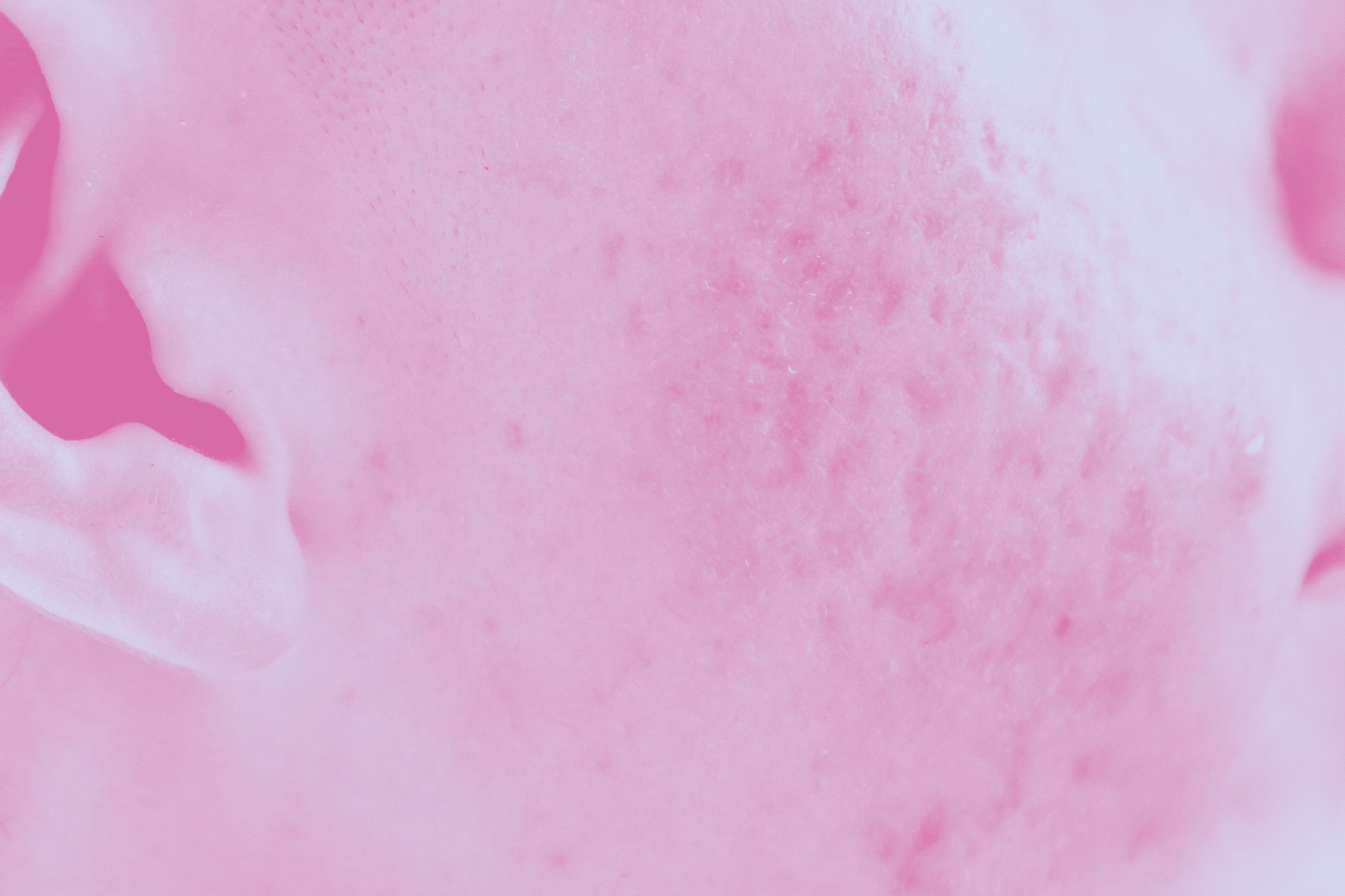 Aftereffects of acne and pimples