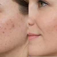 Skin elasticity increased by 28.78%