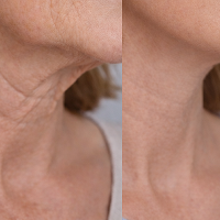 Severity of hyperpigmentation decreased by 11.27%