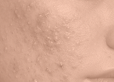 Post-acne marks and acne consequences