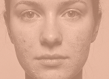Post-procedure and post-peel recovery