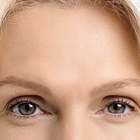 Visible improvement in expression lines observed after a single treatment session.