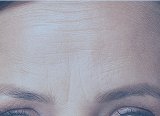 Forehead Lines