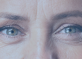 Glabellar Lines (Frown Lines)